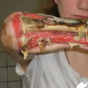 Krokodil Zombie Drug